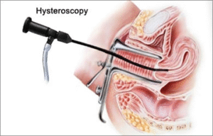 Hysteroscopy Surgery